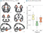 Gray Matter Neuritic Microstructure Deficits in Schizophrenia and Bipolar Disorder